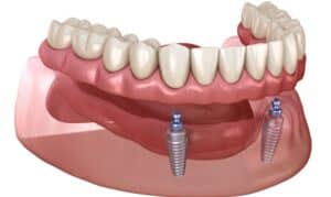 dental implants