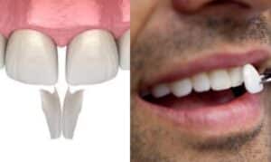 Dental Veneers vs Dental Bonding
