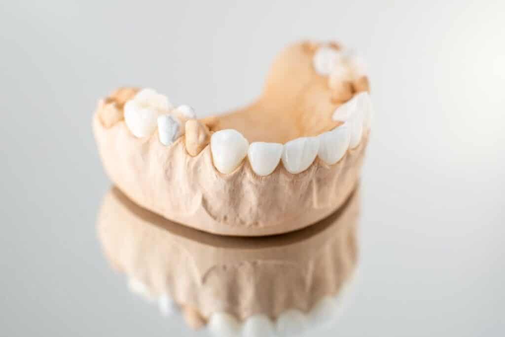 veneers on model teeth