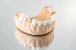 veneers on model teeth