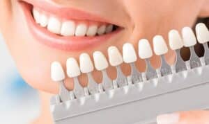 Dental Veneers