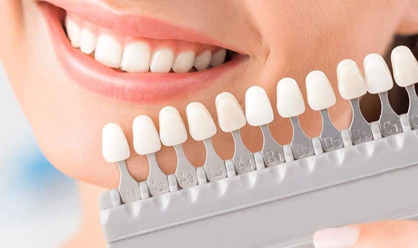 Dental Veneers
