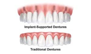 Dentures vs Implant Dentures