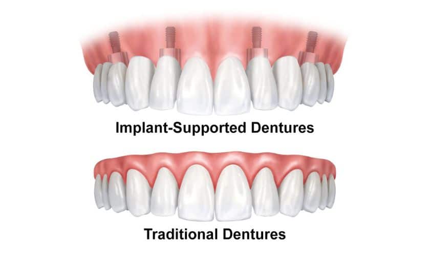 Dentures vs Implant Dentures