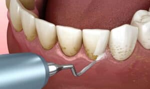 periodontal disease treatments
