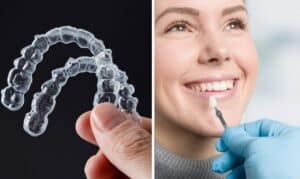 invisalign vs veneers