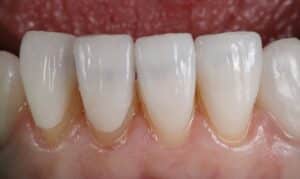 cosmetic teeth bonding