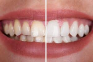 teeth whitening and teeth strength
