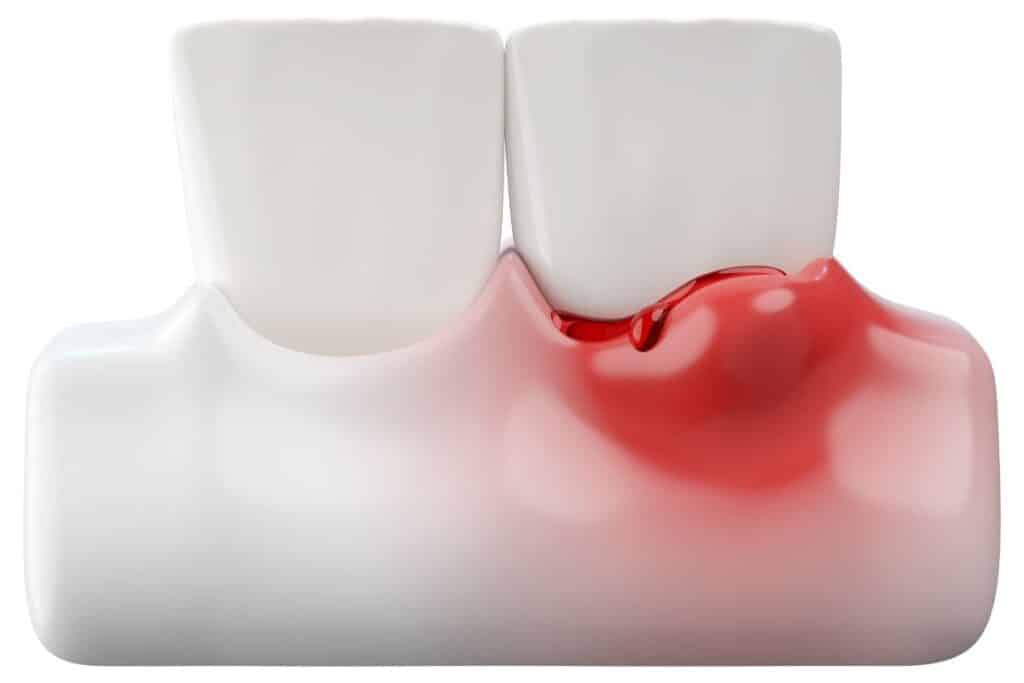 Gum Disease Demonstration with model teeth