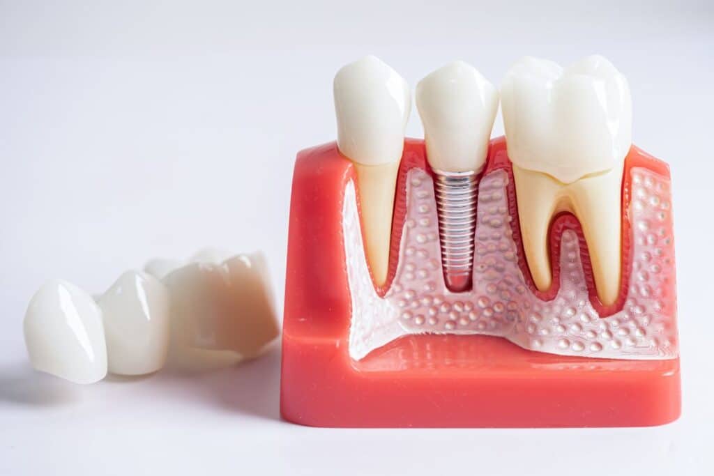 dental implant components