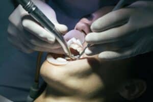 professional dental cleaning