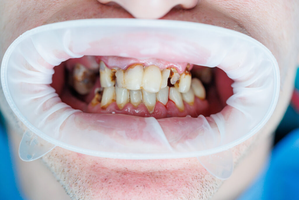 Alcohol Affects Your Teeth and Gums