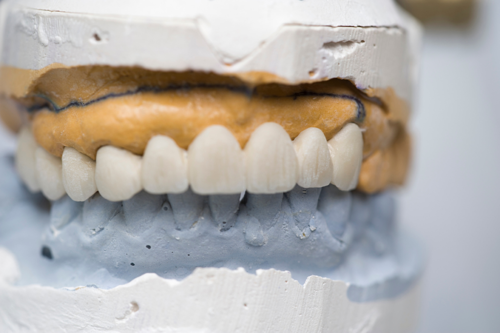 Dental model showing white tooth restorations on upper arch with tan and gray base models.