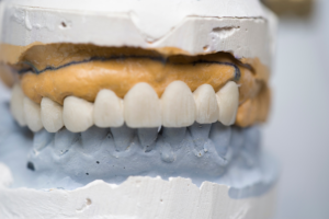 Dental model showing white tooth restorations on upper arch with tan and gray base models.