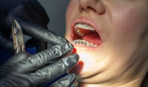 Dental Fillings in Niceville